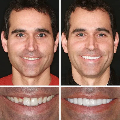 🔥 Custom-Fit Instant Smile Dentures™ – Natural Look & Comfort Fit | 50% OFF Today
