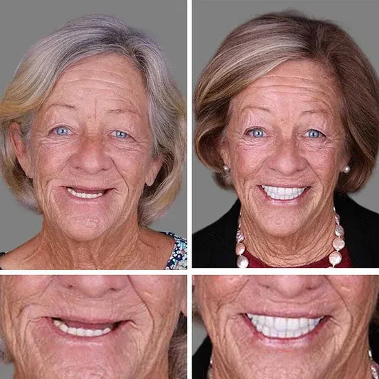 🔥 Custom-Fit Instant Smile Dentures™ – Natural Look & Comfort Fit | 50% OFF Today