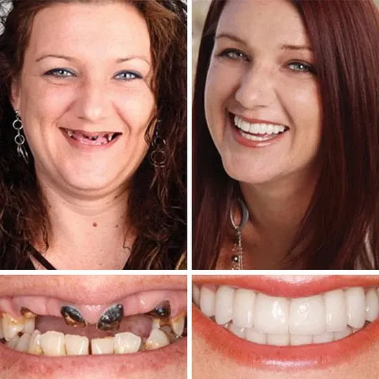 🔥 Custom-Fit Instant Smile Dentures™ – Natural Look & Comfort Fit | 50% OFF Today