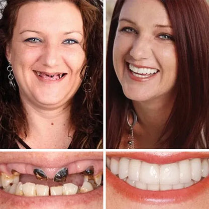 🔥 Custom-Fit Instant Smile Dentures™ – Natural Look & Comfort Fit | 50% OFF Today