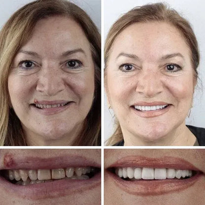 🔥 Custom-Fit Instant Smile Dentures™ – Natural Look & Comfort Fit | 50% OFF Today